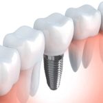 Implantologia - Dentista a Villa Guardia