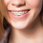 Ortodonzia a Como. Apparecchi per denti classici e invisibili