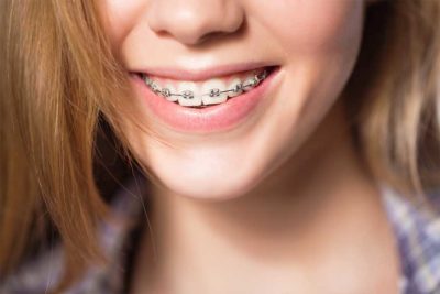 Ortodonzia a Como. Apparecchi per denti classici e invisibili