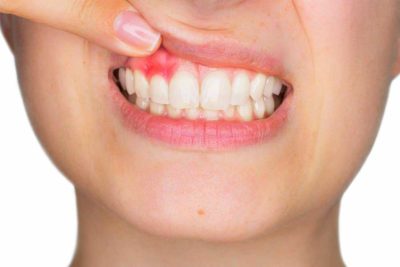 paradontologia e gengive infiammate. Dentista a Villa Guardia
