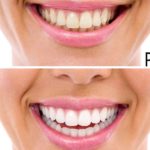 Sbiancamento denti a Como - Dentista a Como